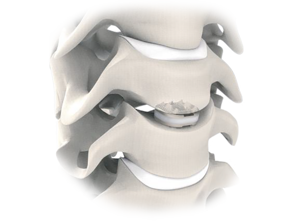 D-Flex Titanium Cervical Disc Prosthesis