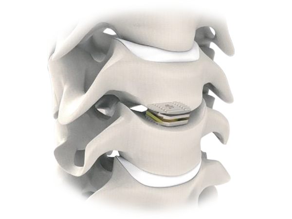 D-Pro Titanium Cervical Disc Prosthesis