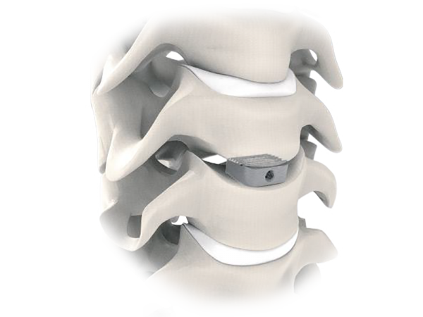Tra-Ti Trabecular Cervical Cage