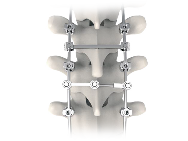 Silver Posterior Thoracolumbar Fixation System