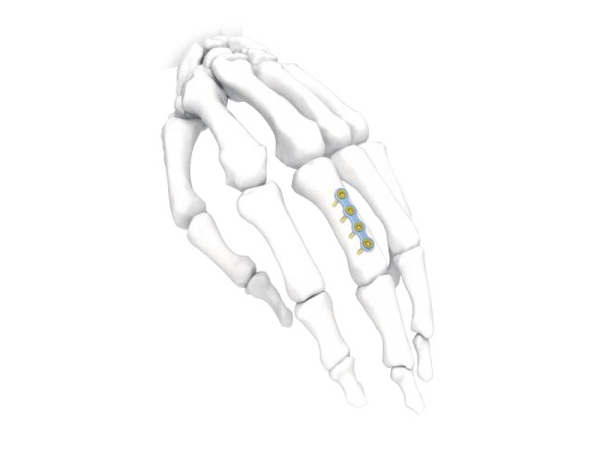 Mini Hand Plate Straight Short