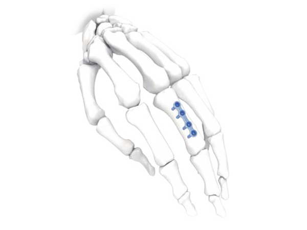 Hand Plate Straight Long