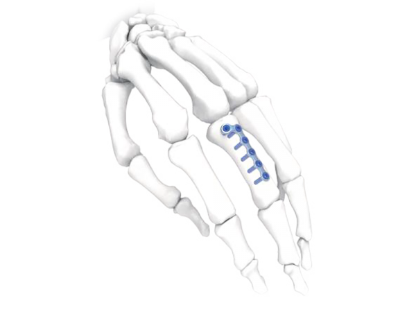 L Oblique Left Hand&Foot Plate